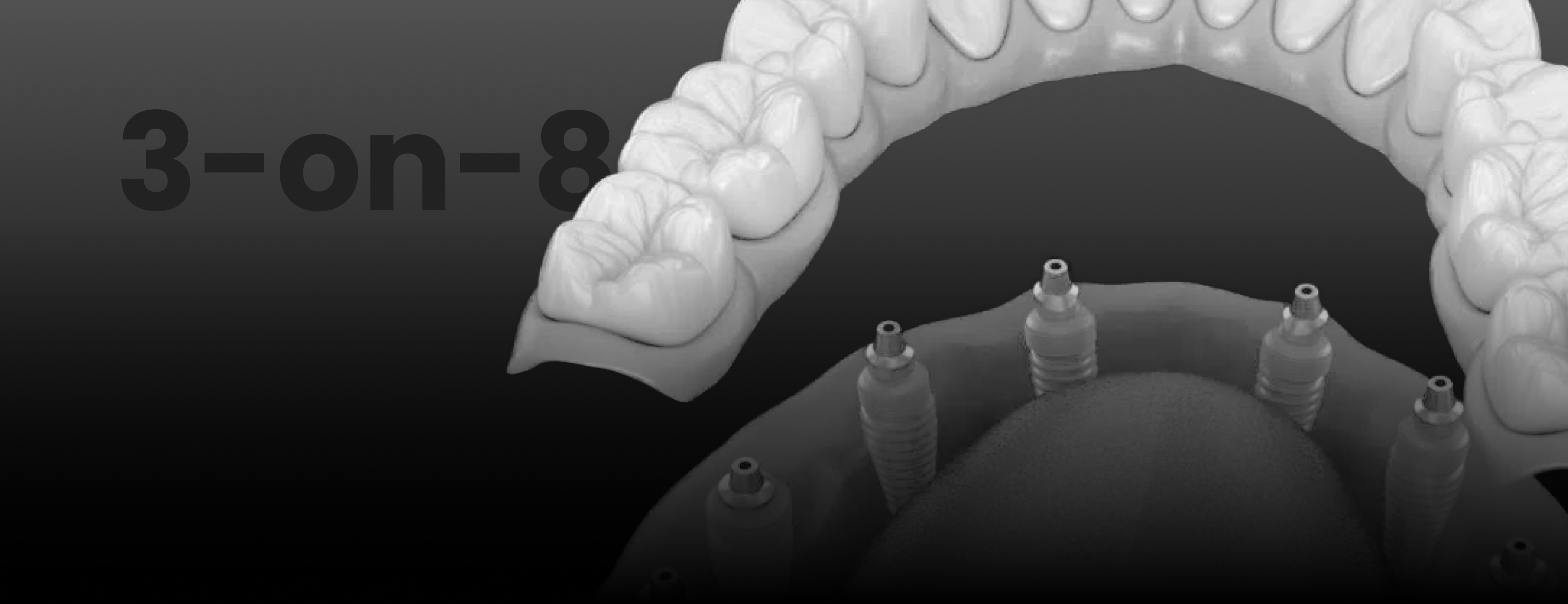 3-On-8 dental implants in Mexico