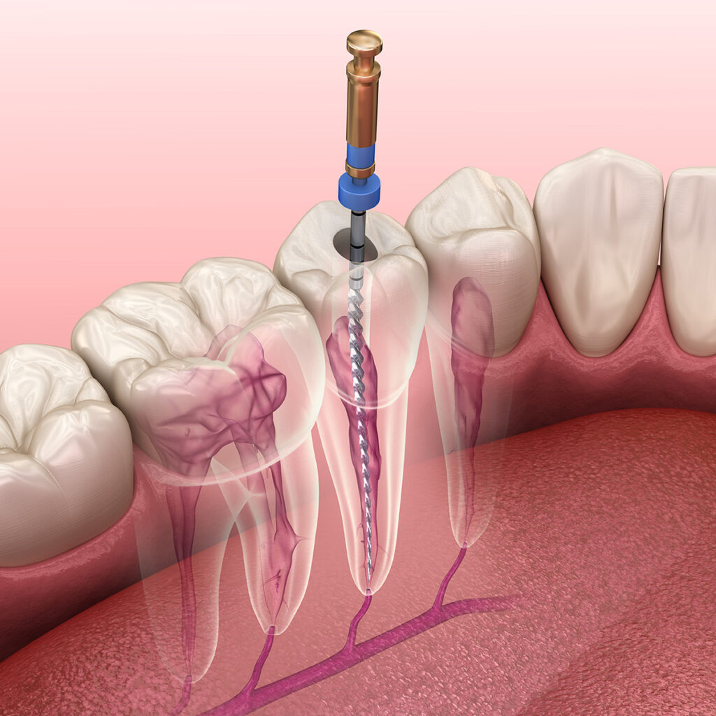 Root Canal Therapy in Mexico