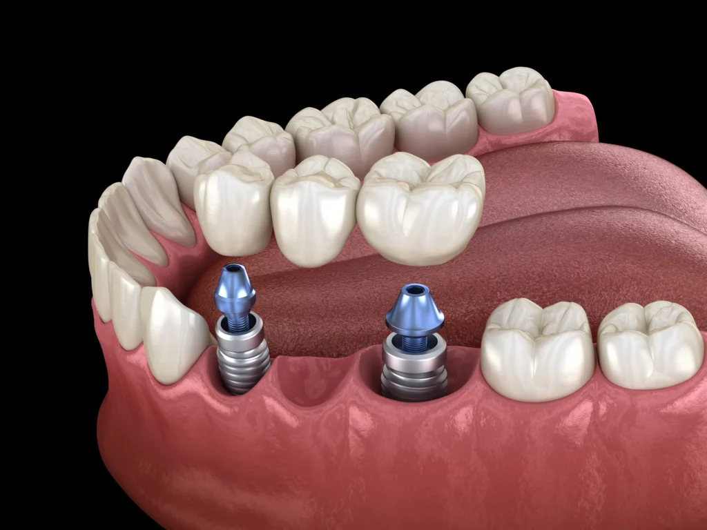 implant-supported-bridge-in-birmingham-st-paul-square-dental-practice Implant-Supported Dental Bridges in Mexico